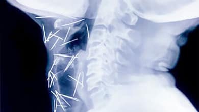 Ses vives douleurs au pied cachaient bien autre chose 14 aiguille dans le corps 2